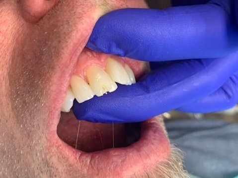 Patient 13 alternate angle of fiber optic DentXpin post positioned inside tooth.