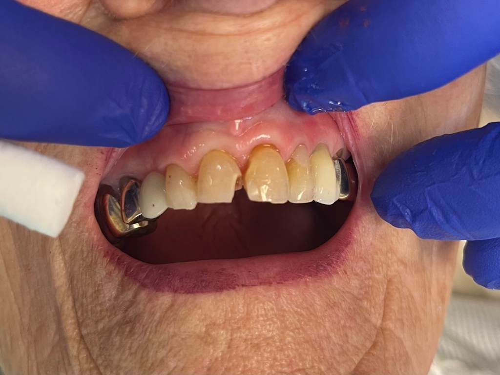 Patient 1 before repair showing chipped tooth prior to DentXpin restoration.