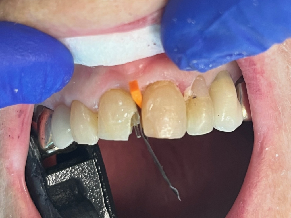 Patient 1 fiber post placement during DentXpin procedure to reinforce damaged tooth.