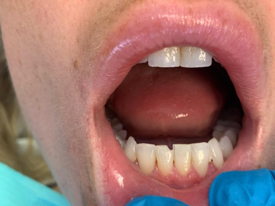 Patient 10 chipped lower front tooth prior to DentXpin fiber optic post restoration.