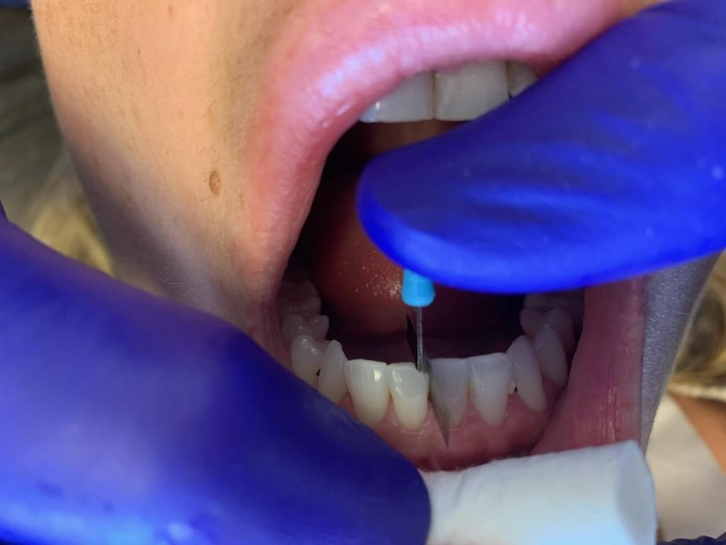 Patient 10 placement of DentXpin fiber optic post.