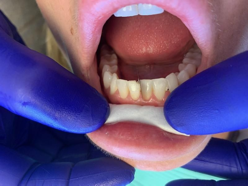 Patient 10 DentXpin fiber optic post size and placement prior to reconstructing.