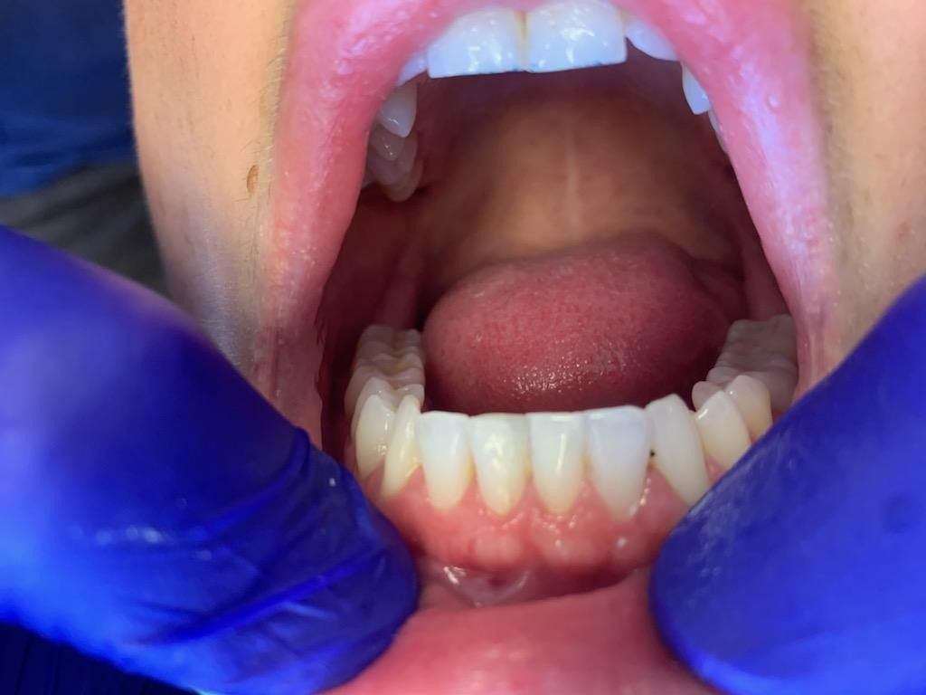 Patient 10 restored tooth after fiber optic DentXpin reinforcement.