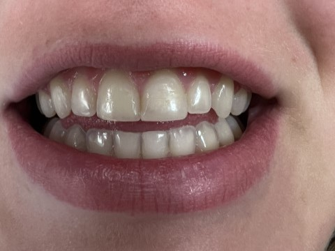 Patient 11 completed tooth repair following DentXpin treatment.