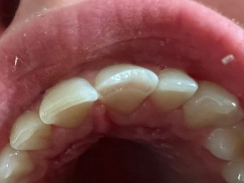 Patient 11 alternate angle of damaged tooth before DentXpin procedure.