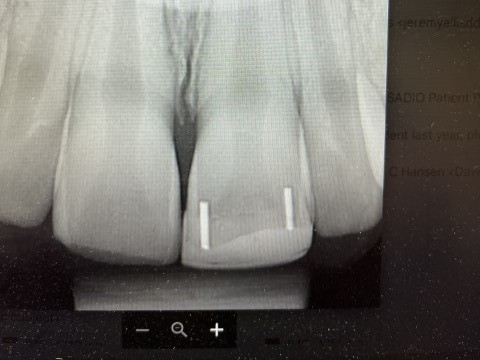 Patient 11 x-ray showing completed tooth repair following DentXpin treatment.