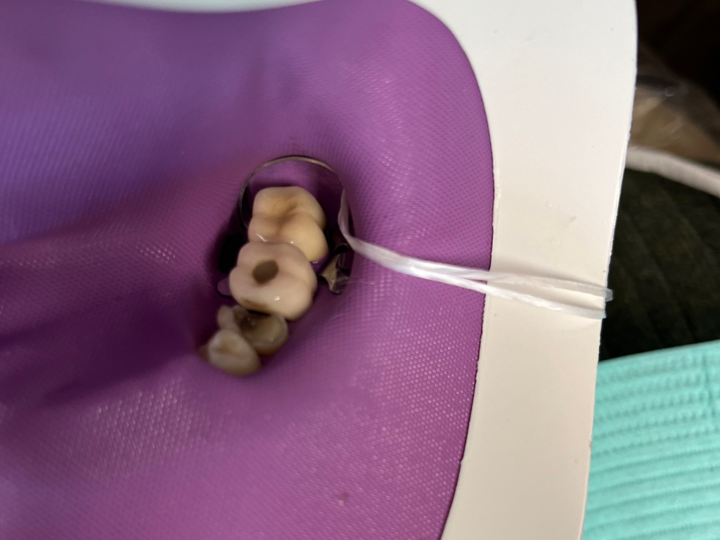 Patient 12 preparing for fiber optic post placement.