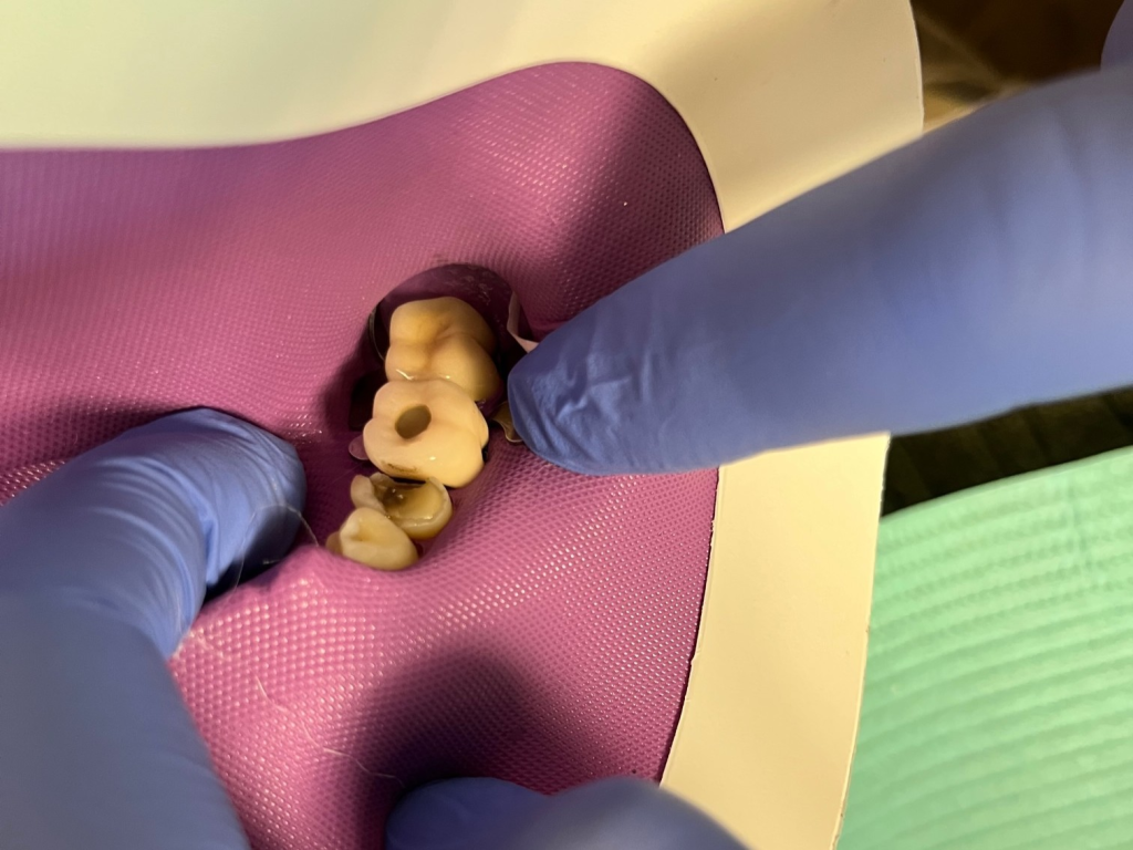 Patient 12 internal tooth preparation prior to DentXpin insertion.