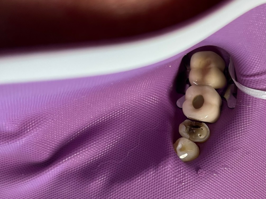 Patient 12 DentXpin fiber optic positioning prepared.