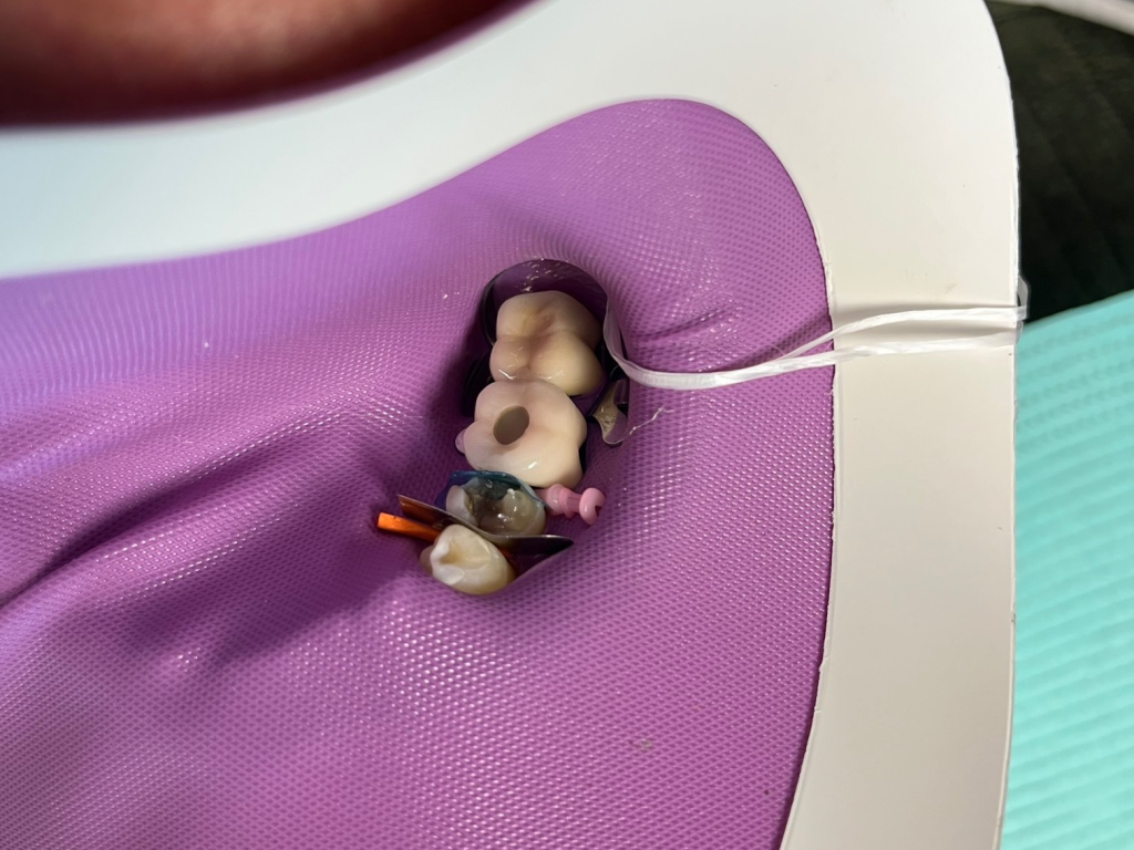 Patient 12 core buildup completed over DentXpin for structural reinforcement - angle 1.
