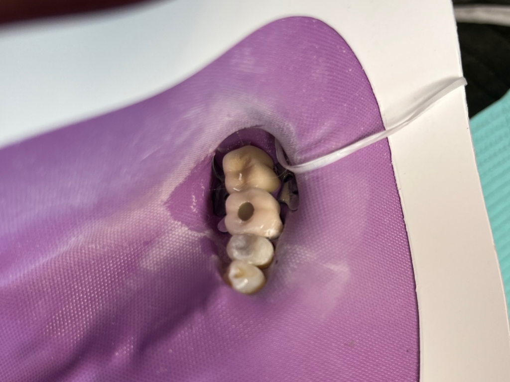 Patient 12 final contouring of restored tooth after fiber optic post treatment.