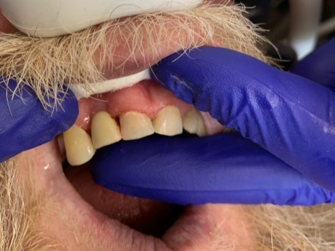 Patient 2 restored tooth after DentXpin fiber optic reinforcement with natural contour.