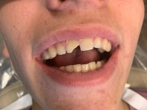 Patient 3 chipped front tooth before DentXpin fiber optic treatment.