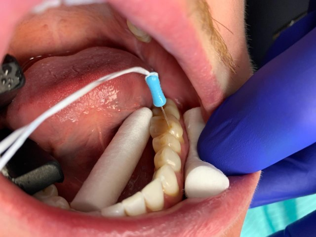 Patient 4 Initial DentXpin fiber optic post inserted.