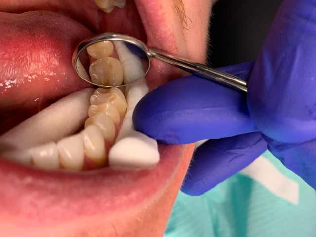 Patient 4 final tooth restoration after DentXpin fiber optic reinforcement.