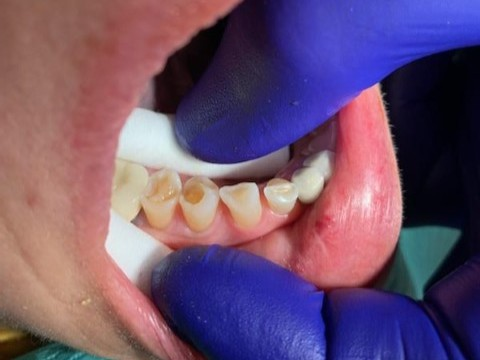 Patient 5 before image showing compromised tooth requiring fiber optic post support.