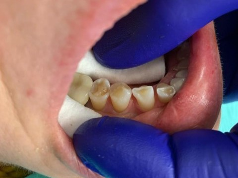 Patient 5 restored tooth following DentXpin fiber optic post treatment.