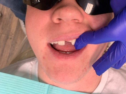 Patient 6 before image showing broken front tooth requiring fiber optic post support.