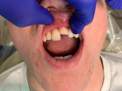 Patient 6 before image showing another angle of broken front tooth.