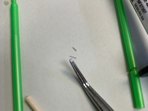 Patient 6 DentXpin fiber optic pieces used to reinforce tooth structure.