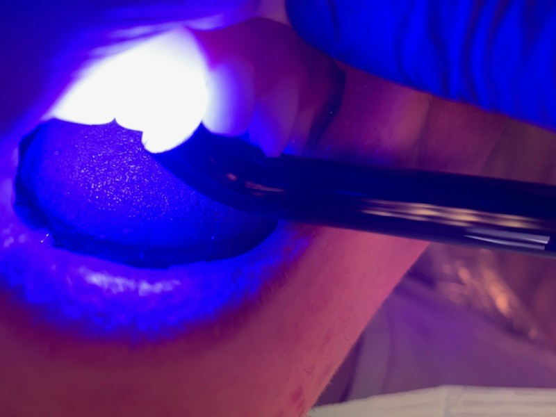 Patient 6 DentXpin fiber optic pieces and tooth reconstruction curing.