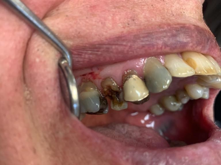 Patient 8 before image showing fractured tooth requiring reinforcement.