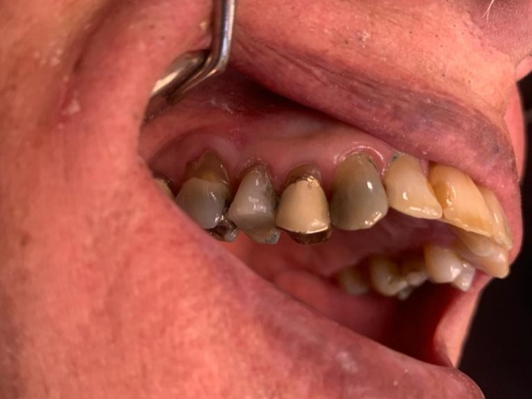 Patient 8 completed tooth restoration after DentXpin repair.