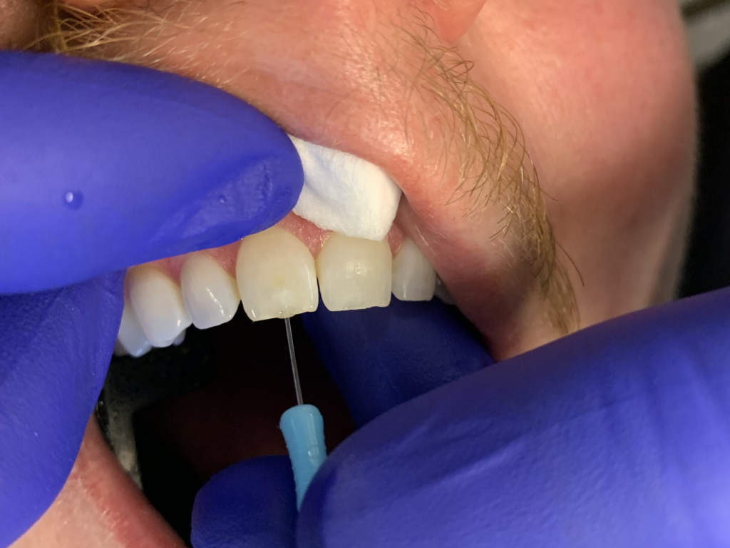 Patient 9 - DentXpin fiber optic post fit during restorative process.
