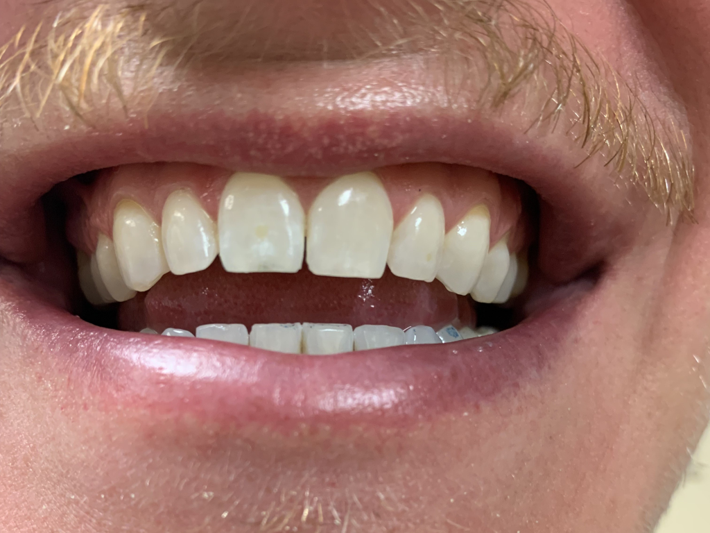 Patient 9 final restored tooth after DentXpin fiber optic reinforcement.