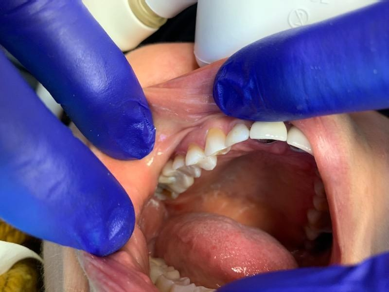 Patient 7 final restored tooth after DentXpin repair - angle 1.