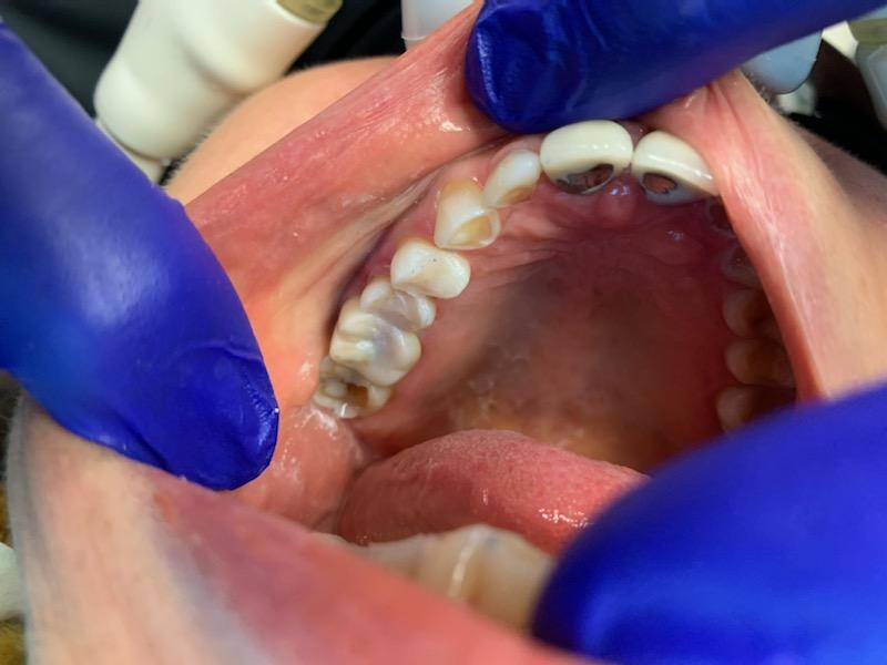 Patient 7 final restored tooth after DentXpin repair - angle 2.