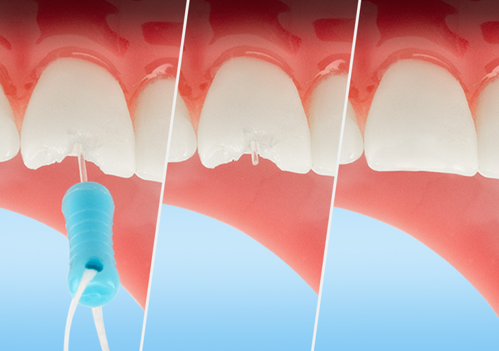 DentXpin insertion progression images with final product.