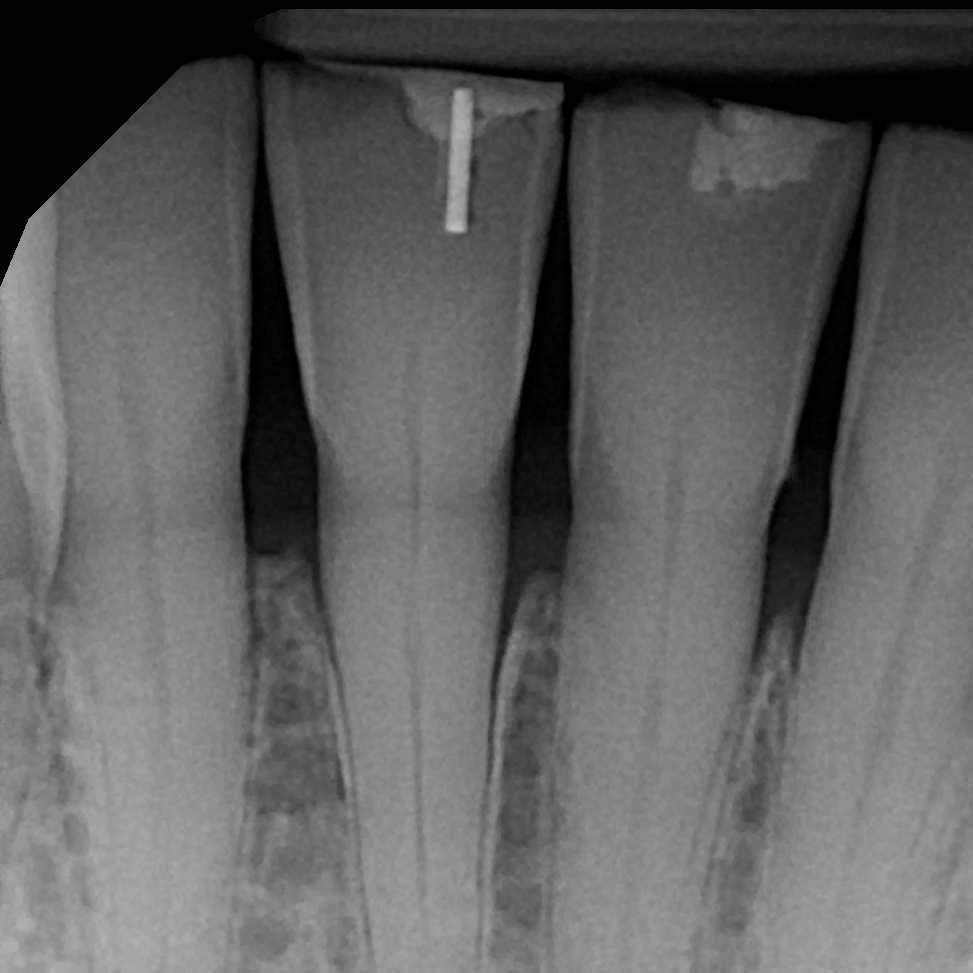 X-ray of DentXpin used in tooth reconstruction