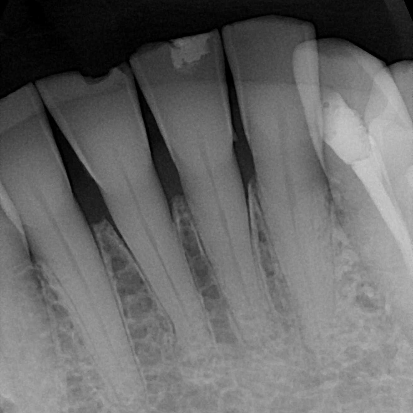 X-ray of before DentXpin tooth reconstruction